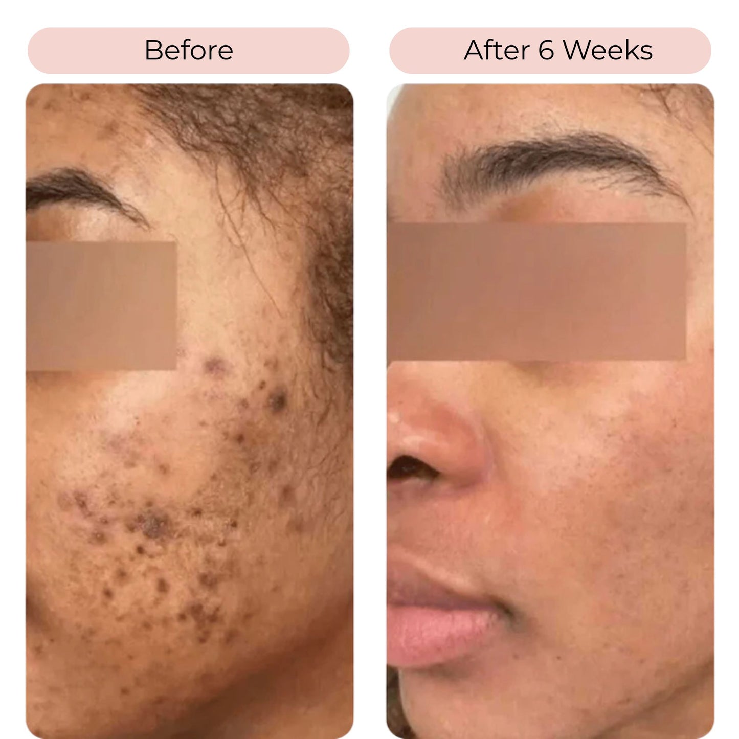 TurmKo™ - Turmeric & Kojic Acid Cleansing Pads (2x40 pcs)