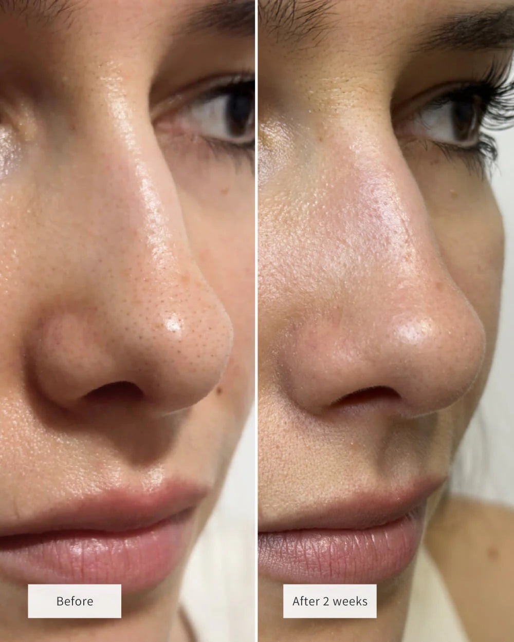 Lunnexi™ - Nose Patches (10pcs)