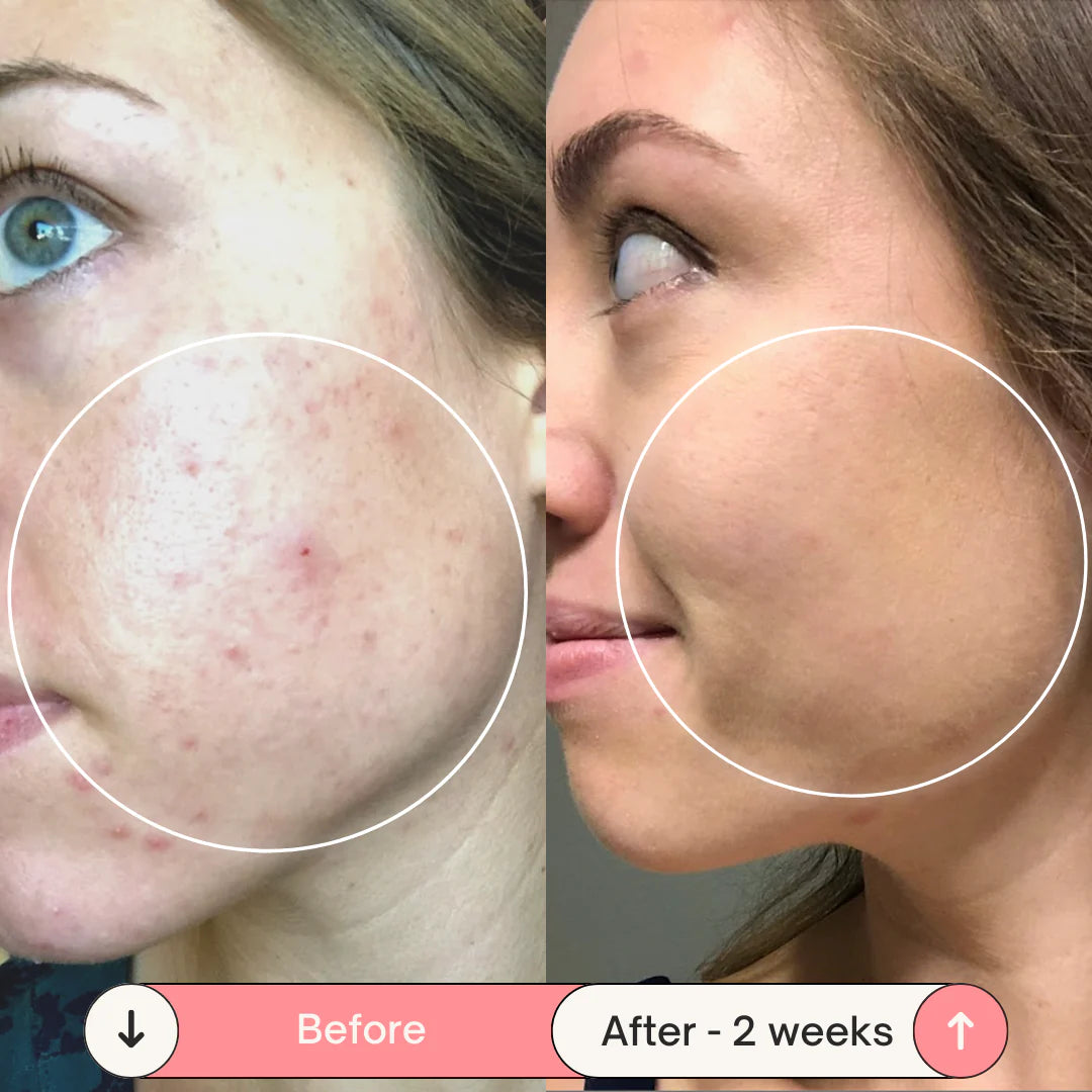 Lunnexi™ - Acne Erasure Wand