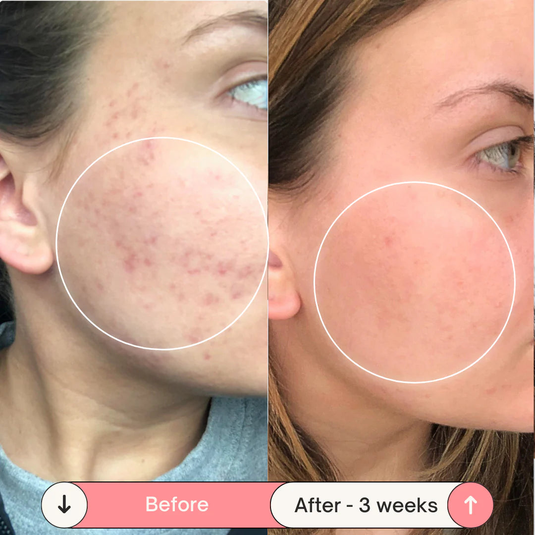 Lunnexi™ - Acne Erasure Wand