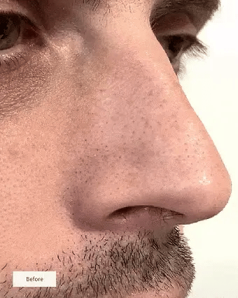 Lunnexi™ - Nose Patches (10 pcs)