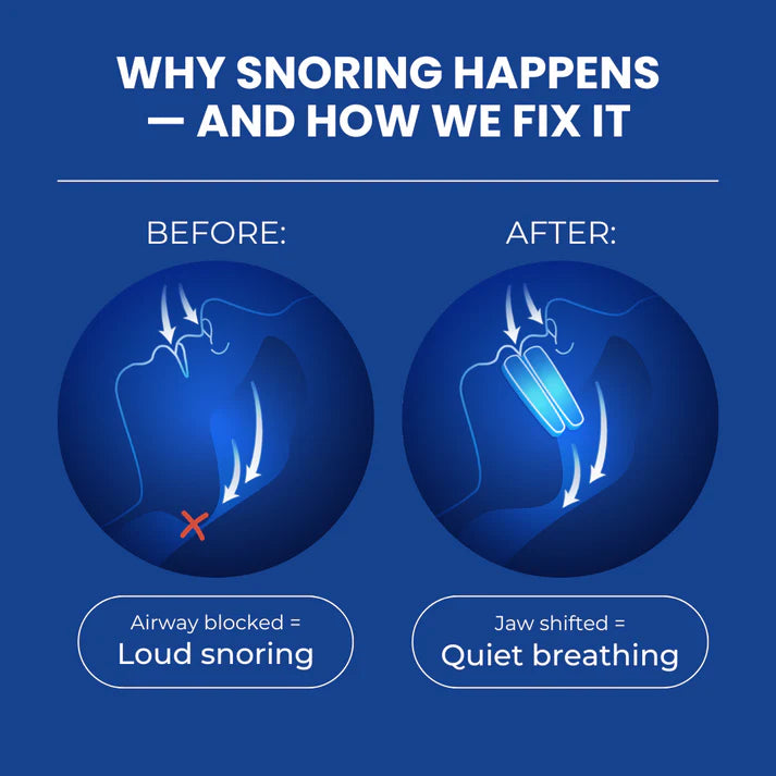 SilentBite™- Anti-Snore Mouthpiece