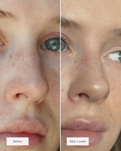 Lunnexi™ - Nose Patches (10pcs)