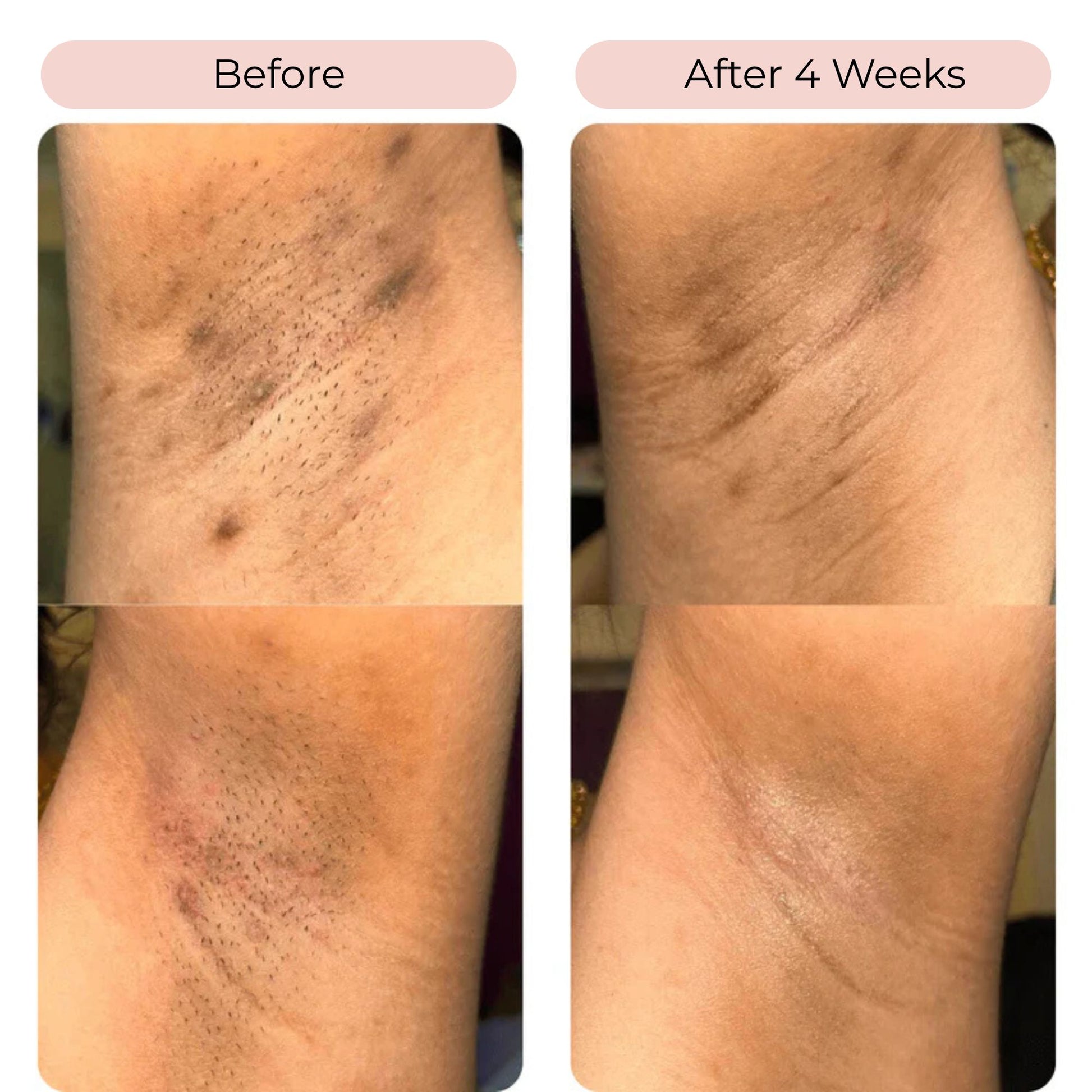 TurmKo™ - Turmeric & Kojic Acid Cleansing Pads (2x40 pcs)