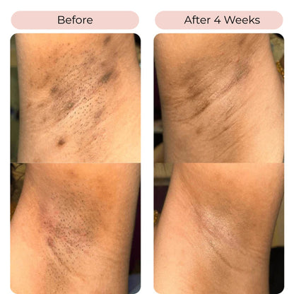 TurmKo™ - Turmeric & Kojic Acid Cleansing Pads (2x40 pcs)