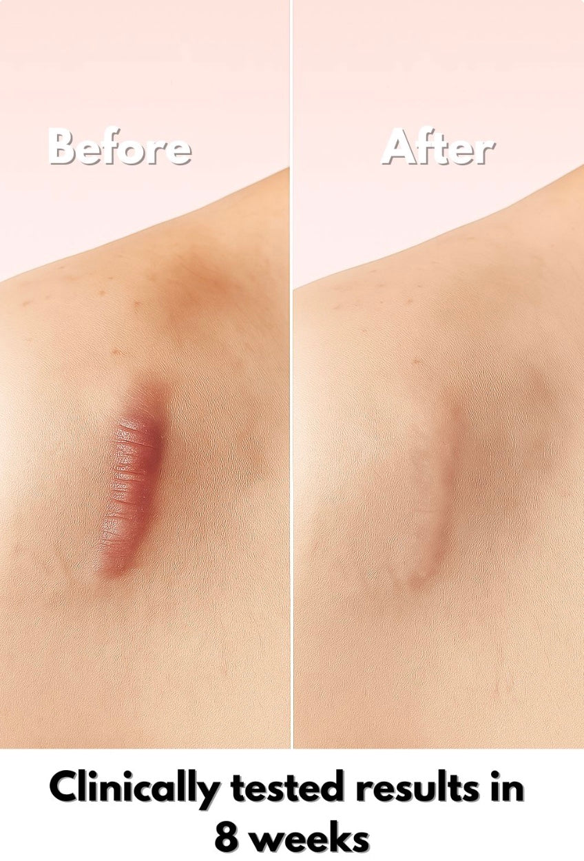 Lunnexi™ - Scar Tape (4x300cm)