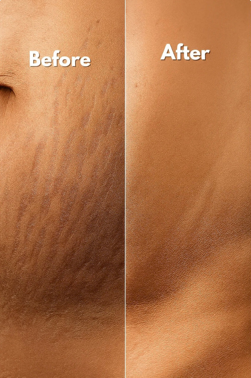 Lunnexi™ - Scar Tape (4x300cm)