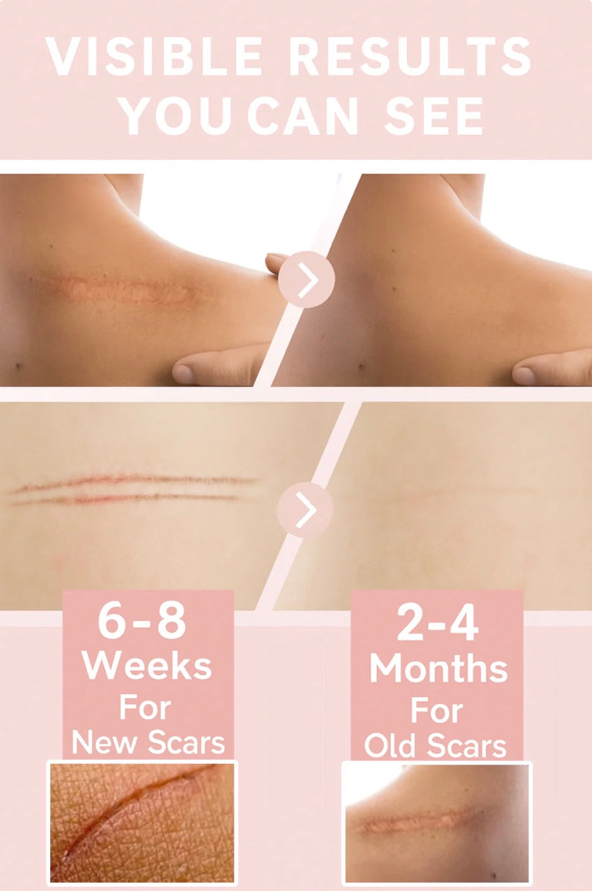 Lunnexi™ - Scar Tape (4x300cm)