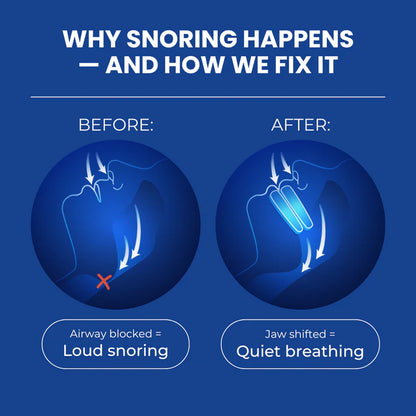 SilentBite™- Anti-Snore Mouthpiece