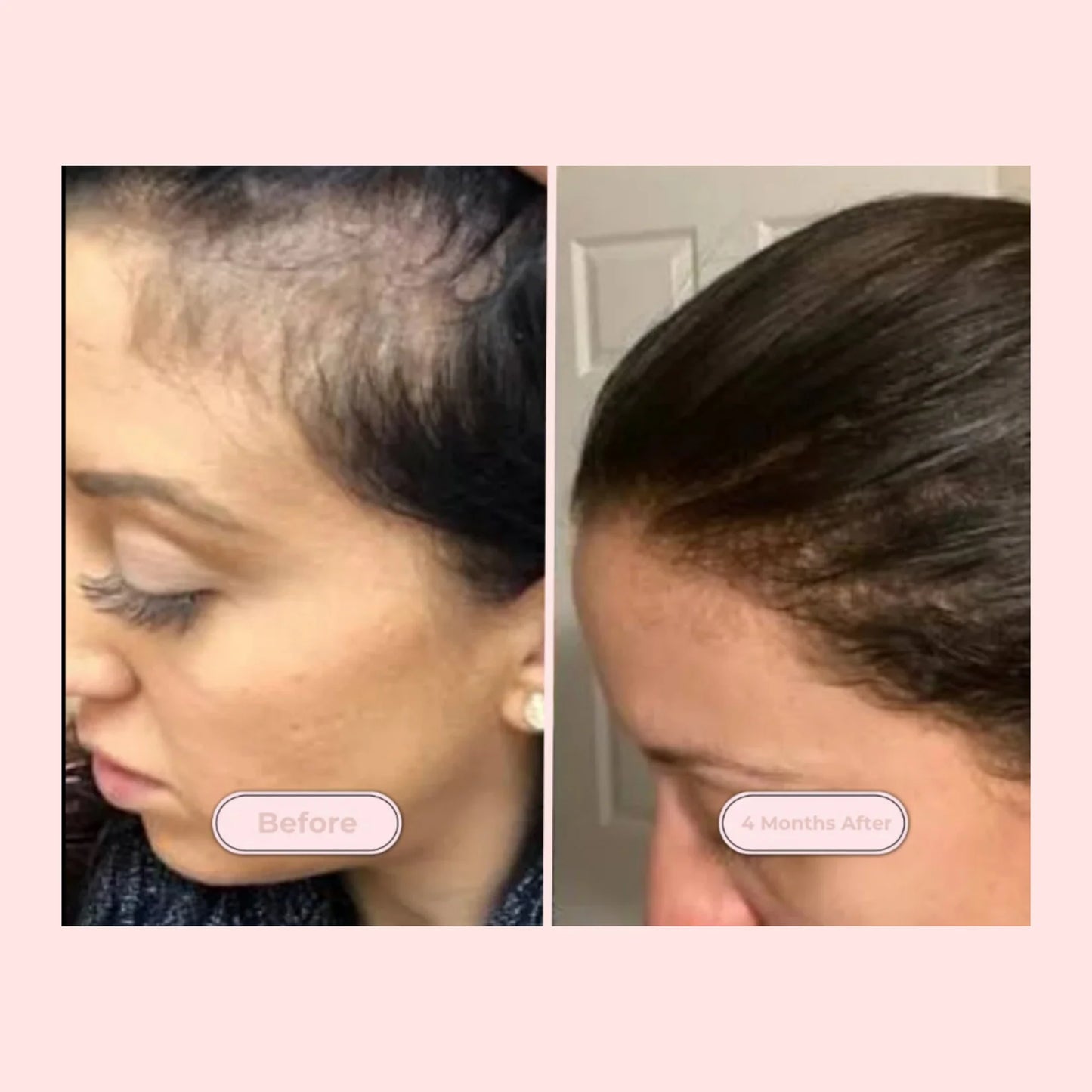 SolarCrown™ - Red Light Therapy Scalp Massager